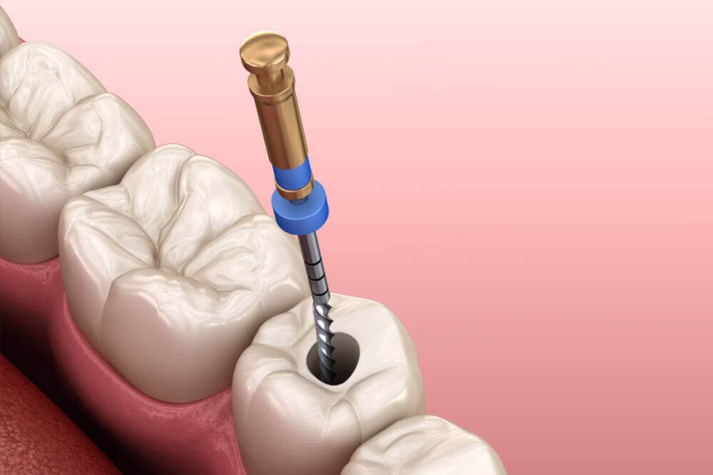 A root canal procedure is done to save the tooth and prevent it from needing to be removed as a result of infection and bacteria.