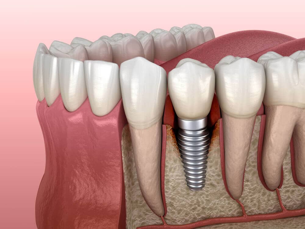 Dental implants provide a look and feel that’s very close to natural teeth. 