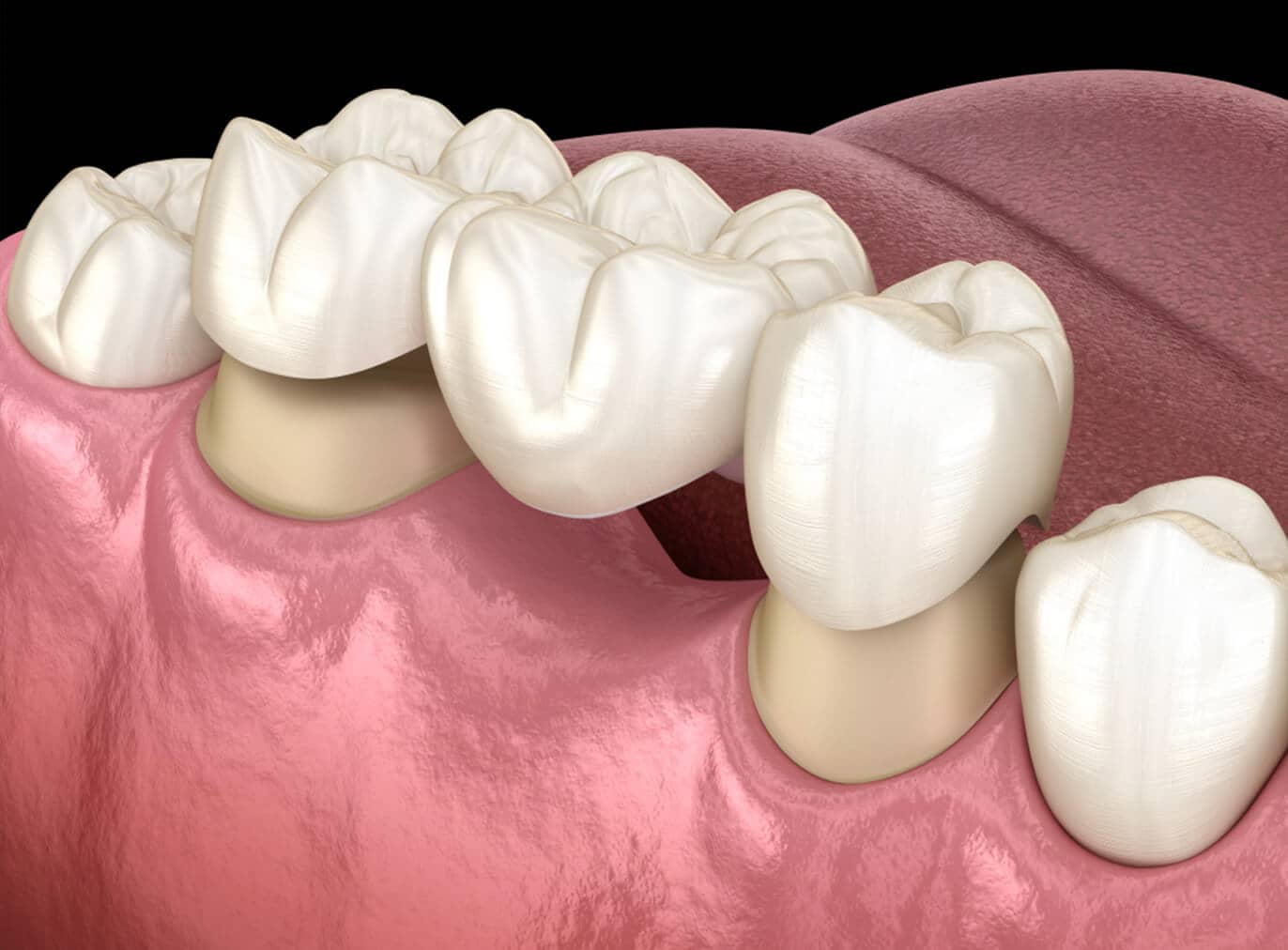 Dental Bridges