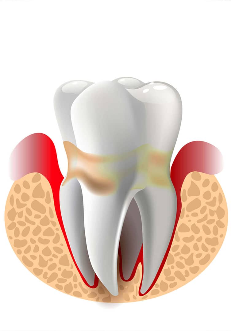 Periodontal disease (also known as gum disease) is an infection of the tissues surrounding and supporting the teeth.